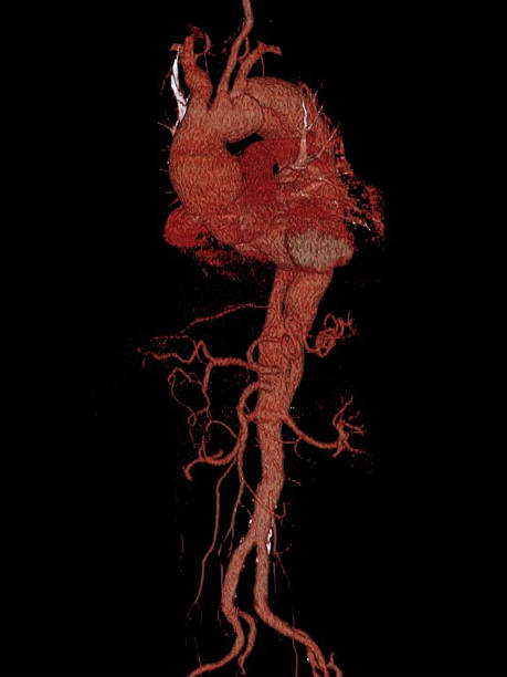 3D computed tomography reconstruction of the heart and aorta This image shows the heart and aorta in acute aortic dissection and aortic aneurysm. Aortic dissection is a life-treating disease requiring high-risk urgent surgery. 3D CT reconstruction is a modern computed technique that can built a volumetric (3D) image  of organs and structures of the human body. arch architectural feature stock pictures, royalty-free photos & images