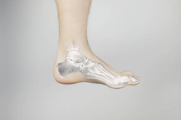 Heel Spur X Ray Stock Photos, Pictures & Royalty-Free Images - iStock