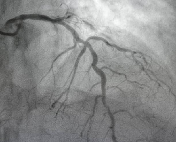 Coronary angiogram , X-ray image. stock photo