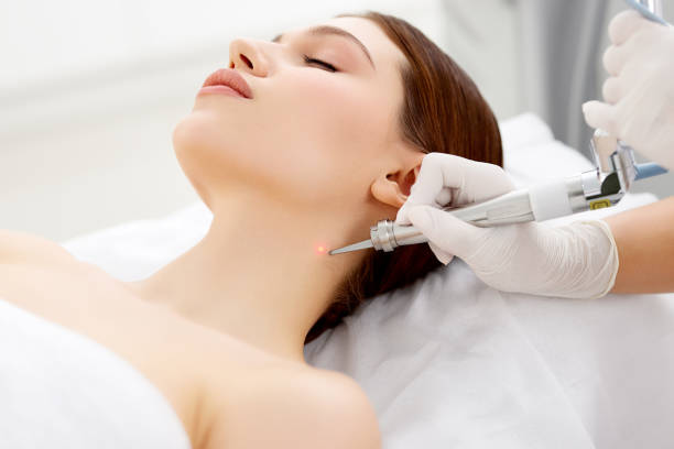 Cosmetologist removing mole with laser machine stock photo