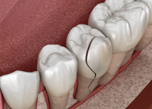 Cracked tooth, splitted. Medically accurate 3D illustration stock photo