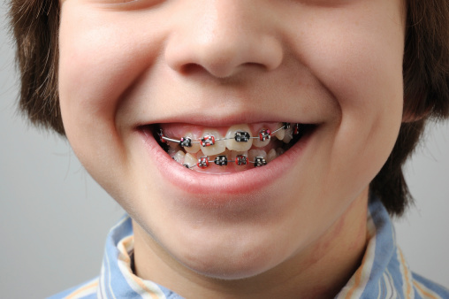 Crooked Teeth With Braces Stock Photo Download Image Now