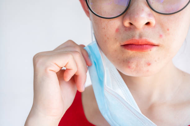 Cropped shot of acne Inflamed occur on woman face after wearing mask for long time during covid-19 pandemic. stock photo
