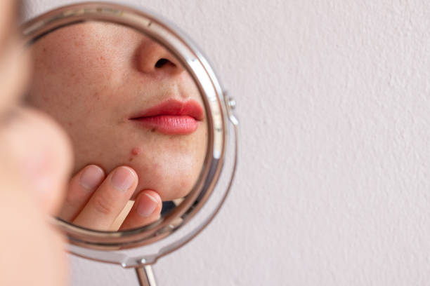 Cropped shot of woman worry about her face when she saw the problem of acne occur on her chin by a mini mirror. stock photo