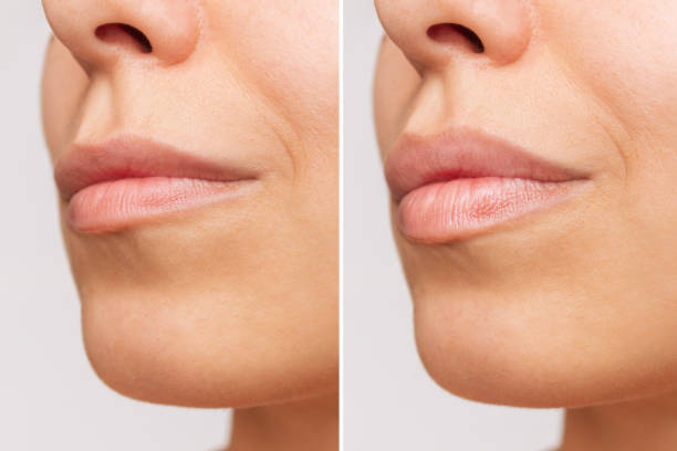 Cropped shot of young women's face with lips before and after lip enhancement Cropped shot of young women's face with lips before and after lip enhancement on a gray background. Injection of filler in lips. Lip augmentation lips stock pictures, royalty-free photos & images
