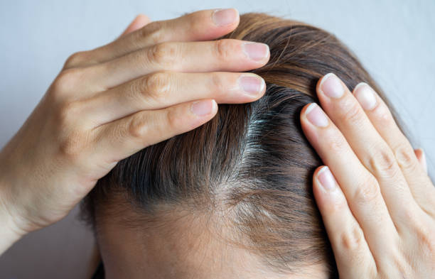 Cropped view of Asian woman forehead with part of her thin hair, she had hair loss problem. stock photo