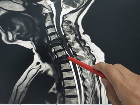 Cervical spondylosis