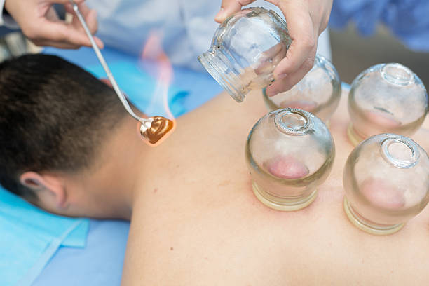 Cupping therapy in traditional chinese medicine stock photo