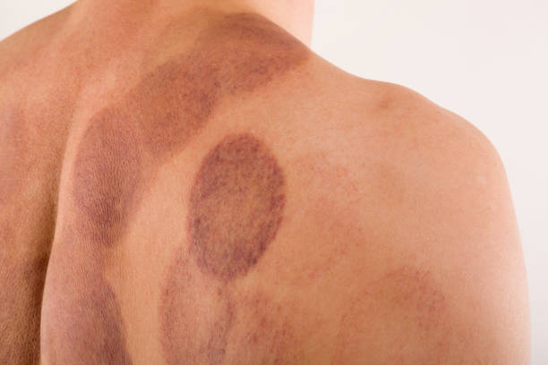 Cupping therapy marks on handsome man's back. Cupping therapy marks on handsome man's back. Massage and wellness concept. cupping therapy stock pictures, royalty-free photos & images