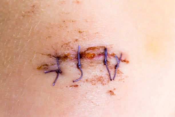 Cut wound with four sutures superimposed stock photo