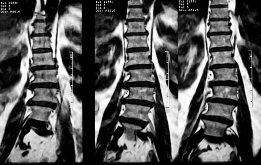 MRI scan of an elderly degenerative scoliotic case.