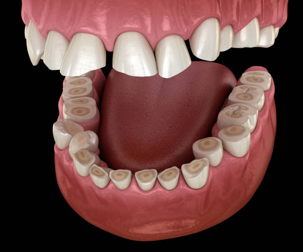 Dental attrition (Bruxism) resulting in loss of tooth tissue.  Medically accurate tooth 3D illustration stock photo