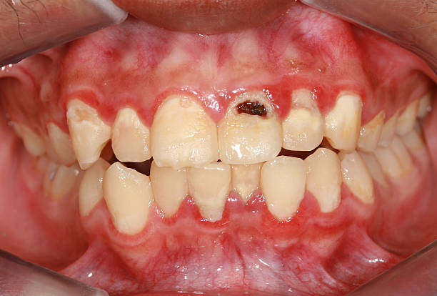 Dental Biofilm stock photo