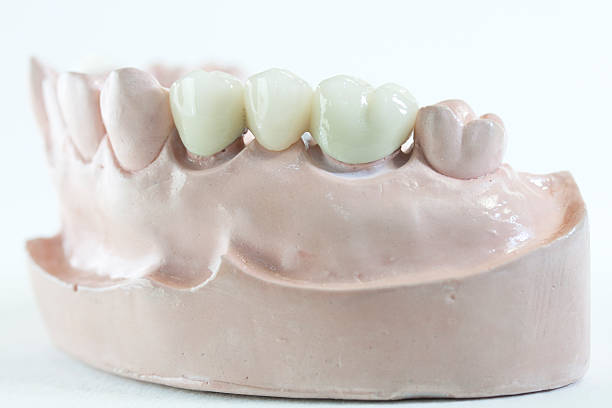 Dental Bridge stock photo