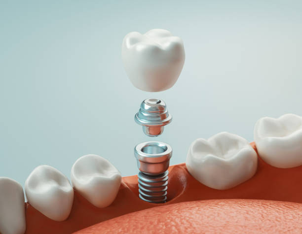 zahnpflege, moderne klinik, 3d rendering - zahnimplantat stock-fotos und bilder