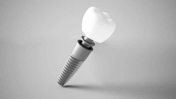 dental implant 3d rendering stock photo