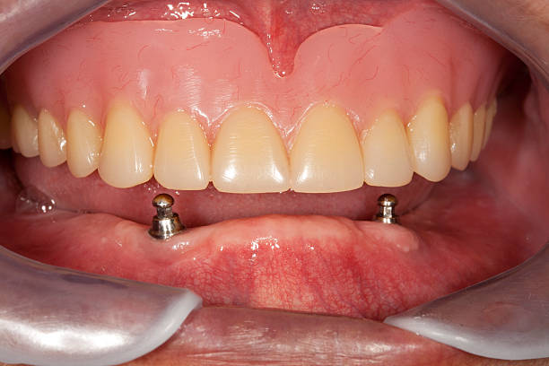 Dental Implant stock photo
