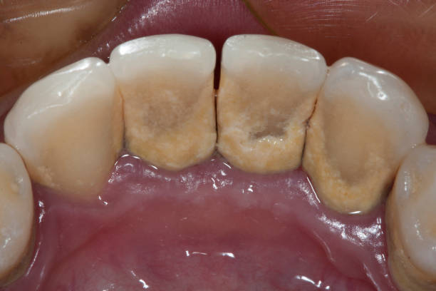 Dental plaque stock photo