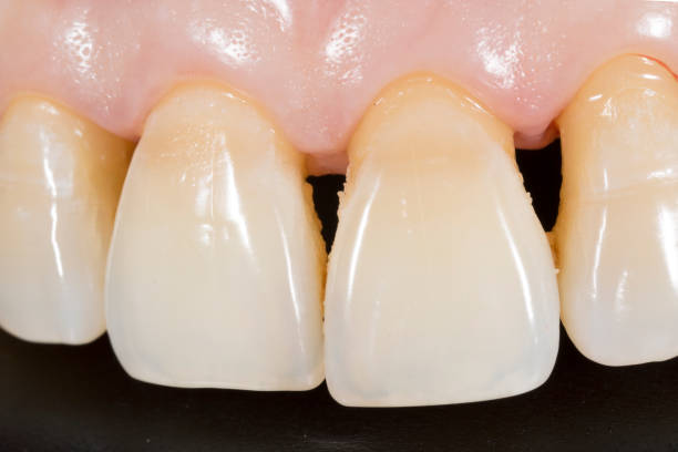 Dental Plaque. stock photo