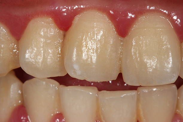dental plaque. stock photo