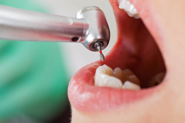 Dental treatment close up stock photo