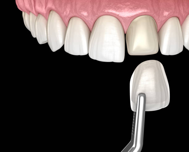 Dental Veneer installation procedure over central incisor. 3D illustration stock photo