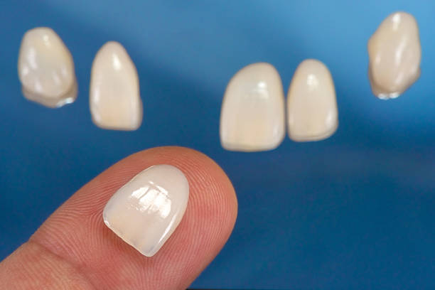 the importance of getting dental veneers