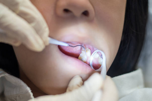 Dentist' hands using mirror and equipment check up teeth and cleaning for young Asia girl child with tooth sealant. Good oral health.  rotten teeth in children stock pictures, royalty-free photos & images