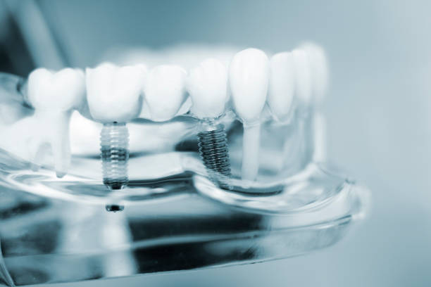 zahnärzte zahn plastikmodell mit schraubenimplantat für lehren, lernen und patienten in der zahnarztpraxis zeigt zähne und zahnfleisch. - zahnimplantat stock-fotos und bilder