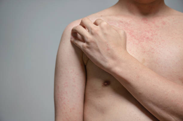 Dermatitis rash viral disease with immunodeficiency on body of young adult asian, scratching with itching stock photo