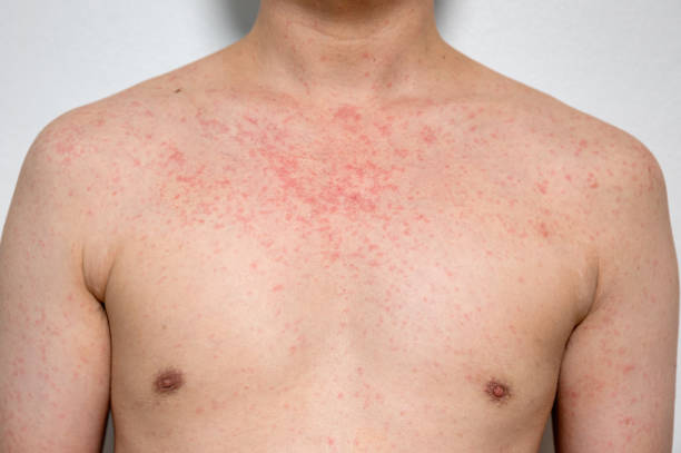 Dermatitis rash viral disease with immunodeficiency on body of young adult asian, scratch with itch stock photo