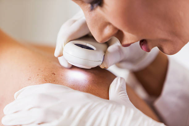 Dermatologist examining patient for signs of skin cancer Female dermatologist (30s) examining male patient's skin with dermascope, carefully looking at a mole for signs of skin cancer. human skin close up stock pictures, royalty-free photos & images