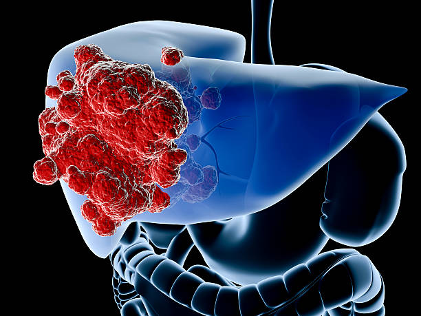 A diagram showing the liver in blue and a cancer in red stock photo