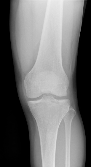 Digital Xray Of The Knee Showing A Tibial Plateau Fracture