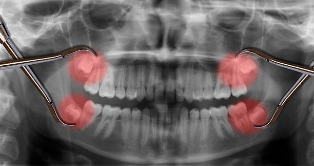 ver quatro sabedoria dentes através de raio- x - sabedoria imagens e fotografias de stock