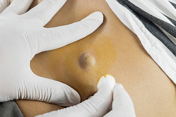 Doctor Diagnosis of the Sebaceous on Woman's Back Doctor Diagnosis of the Sebaceous on Woman's Back cyst photos stock pictures, royalty-free photos & images