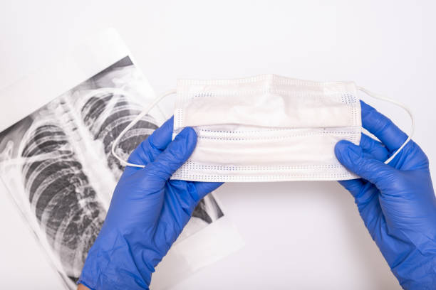 A doctor in medical gloves holding a protactive face surgical mask, an x-ray of lungs on backdrop, pneumonia and bronchitis concept stock photo