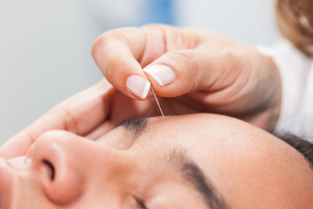 Doctor performing facial acupuncture on a young male patient  acupuncture stock pictures, royalty-free photos & images
