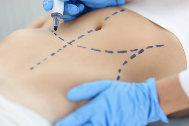 Doctor plastic surgeon drawing preoperative markings on skin of patient abdomen closeup stock photo