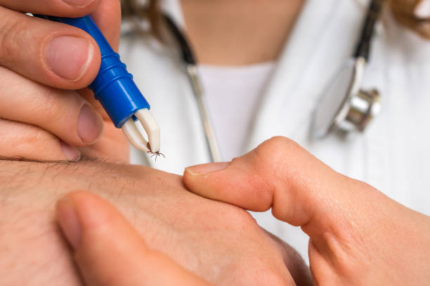 Doctor removing a tick with tweezers from hand of patient stock photo