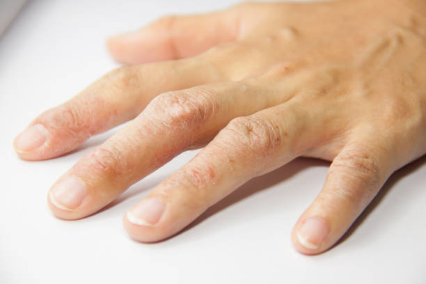 Eczema Dermatitis am HandrÃ¼cken und Fingern - Stockfoto.