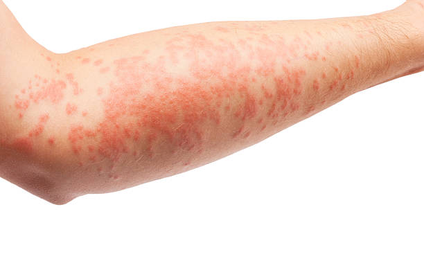 Eczema . Eczema symptom on human skin. human skin close up stock pictures, royalty-free photos & images