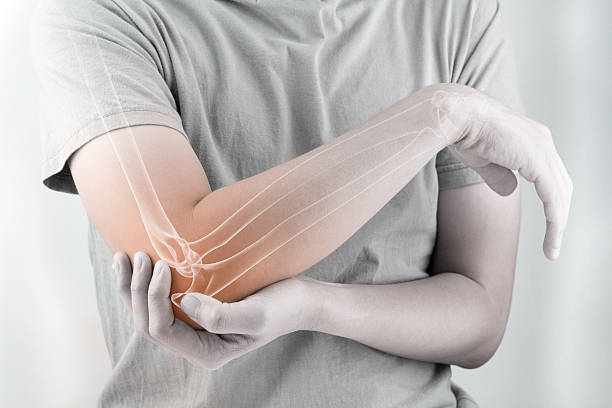 elbow bones injury elbow bones injury white background osteoarthritis stock pictures, royalty-free photos & images