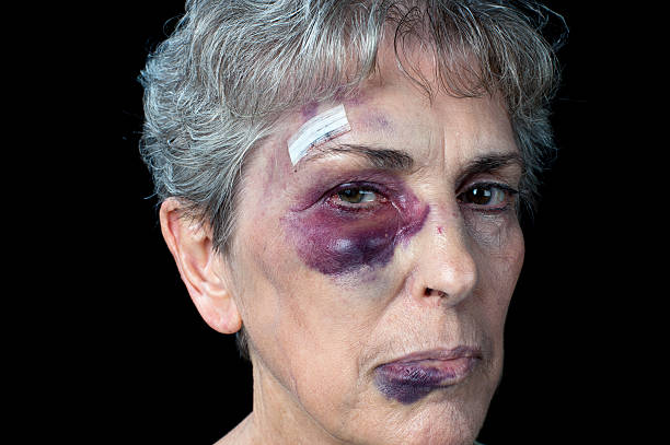 Elderly abuse "An elderly grandmother badly beaten with stitches, a black eye and a fat lip." black eye stock pictures, royalty-free photos & images