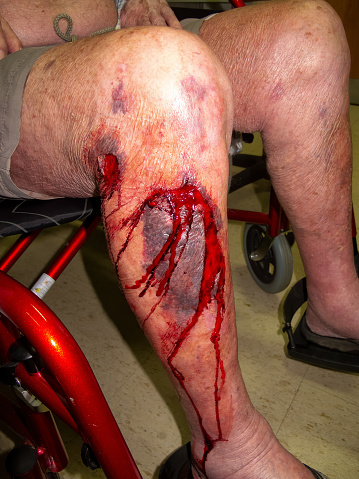 Gambar luka di kaki berdarah
