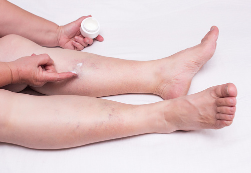 tablete de picior varicoase este posibila unghiile în picior de varicoza