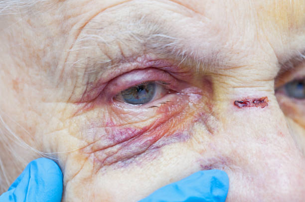 Elderly woman's injured eye & nurse's fingers stock photo