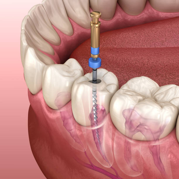 Endodontic root canal treatment process. Medically accurate tooth 3D illustration.  canal stock pictures, royalty-free photos & images