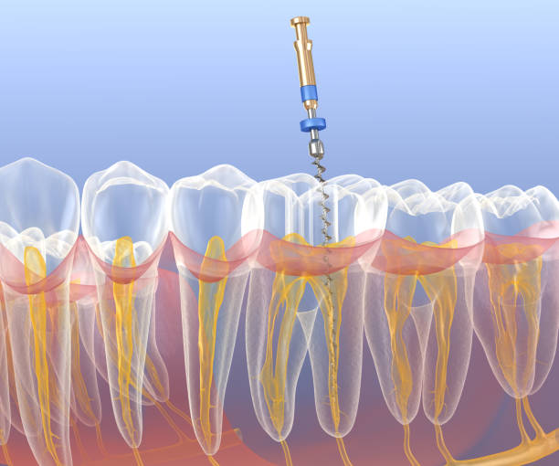 Endodontic root canal treatment process. Medically accurate tooth 3D illustration. stock photo