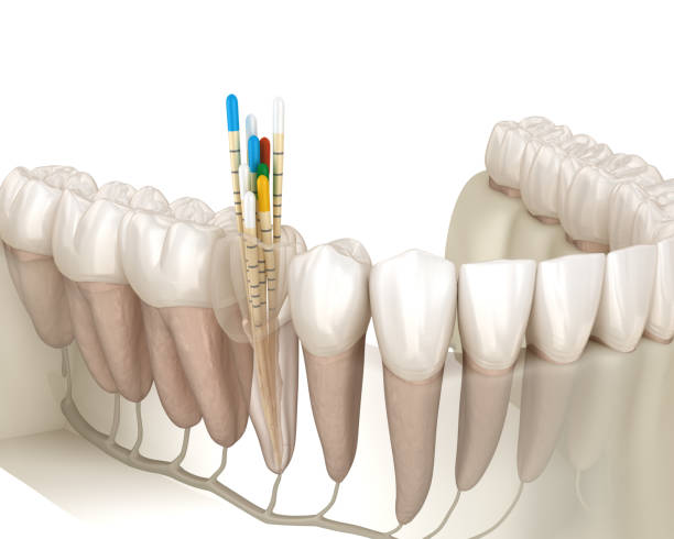 Endodontic root canal treatment process. Medically accurate tooth 3D illustration. stock photo